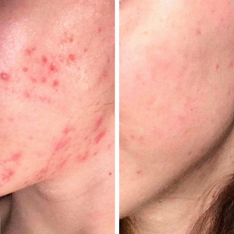 ByePimples - Natürliche Anti-Pickel Behandlung | Eco Bio Boutique